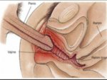 vajinismus nedir